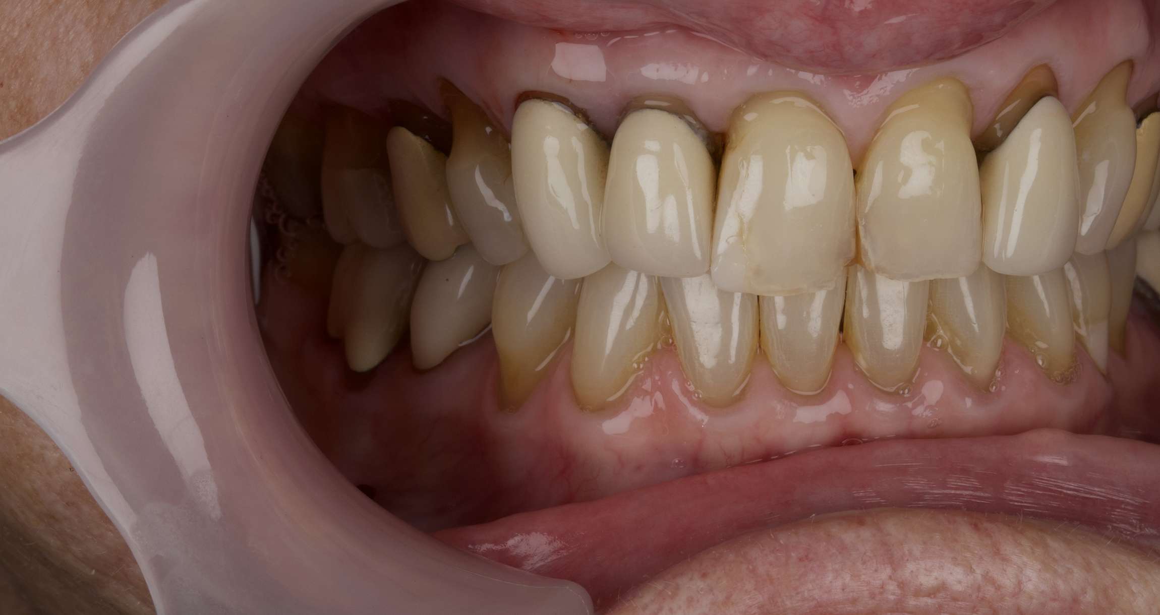 Smile: Before