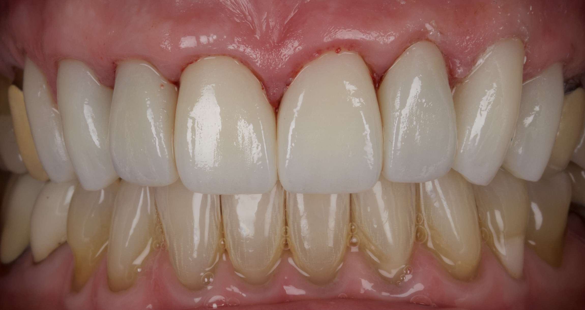 Smile: After