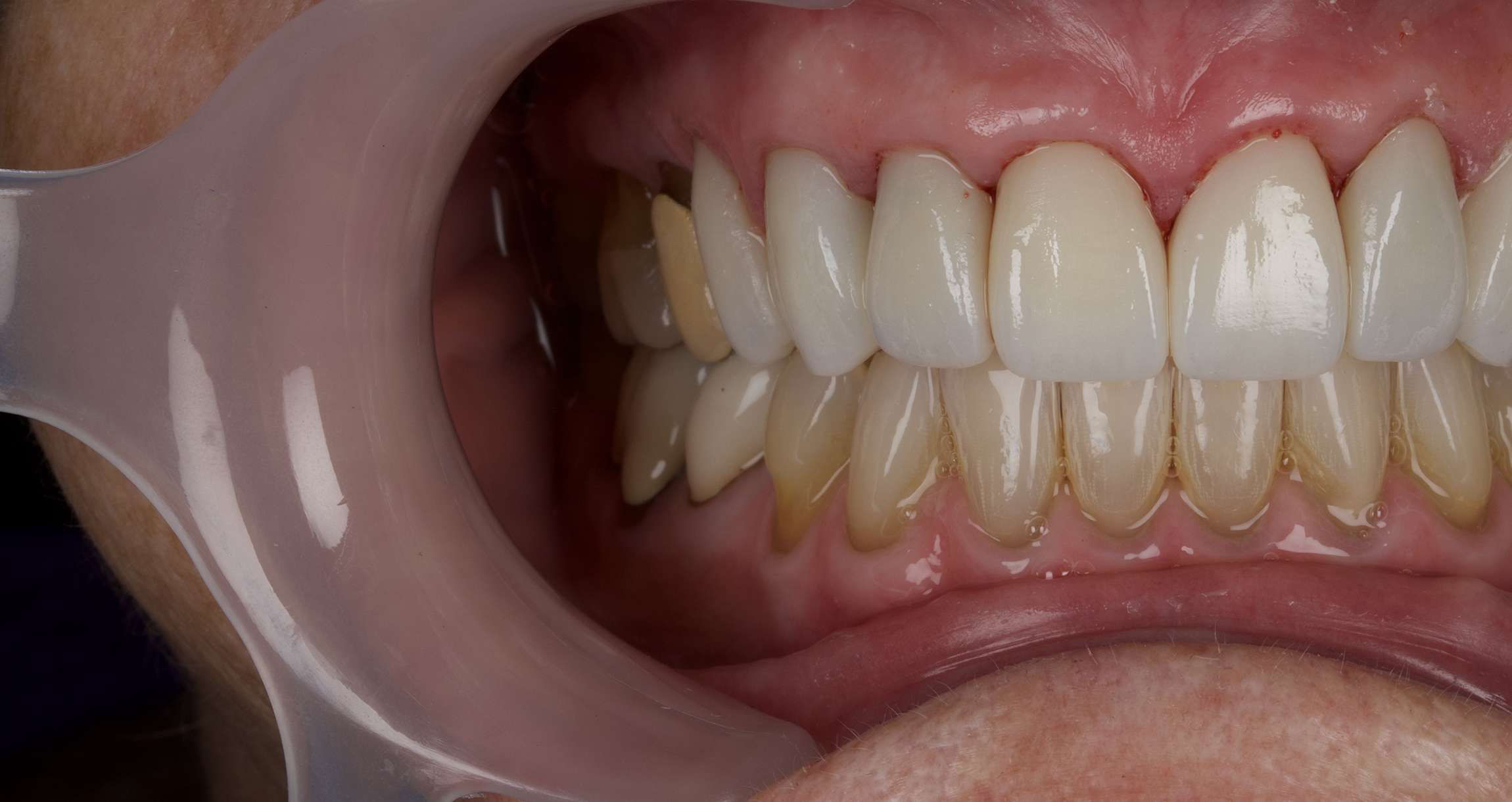 Smile: After
