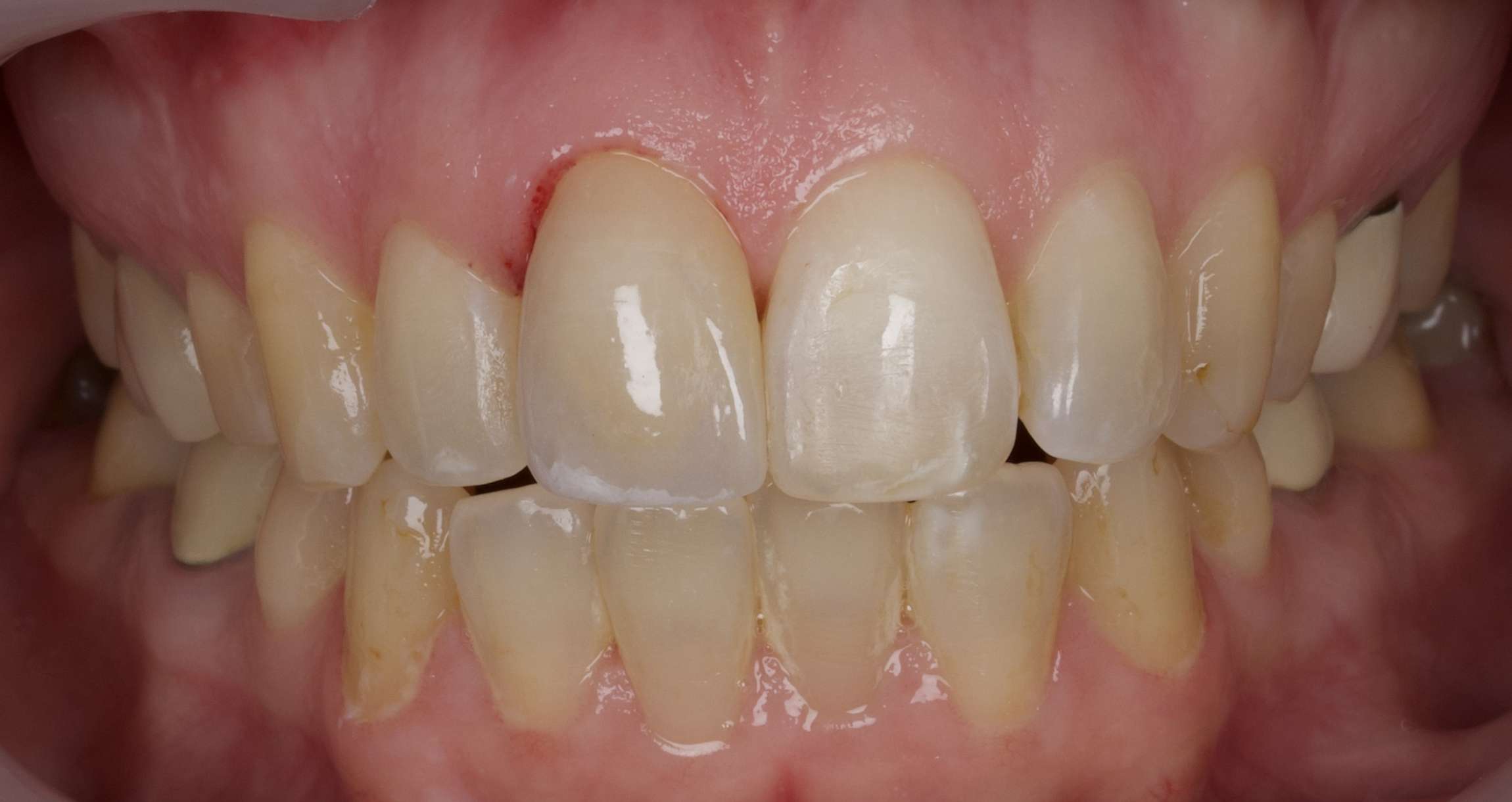 Smile: Before