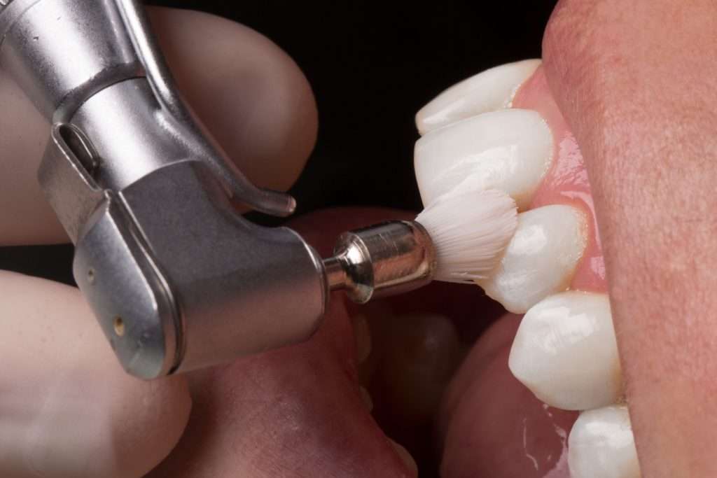 dental cleaning casa adobes az